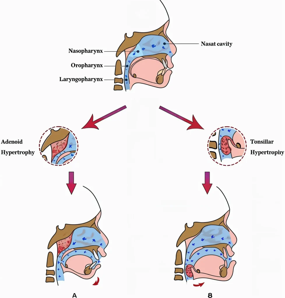 Impact of Mouth Breathing 
