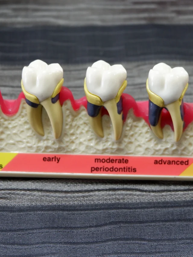 Apexogenesis for Immature Teeth in Pediatric Patients