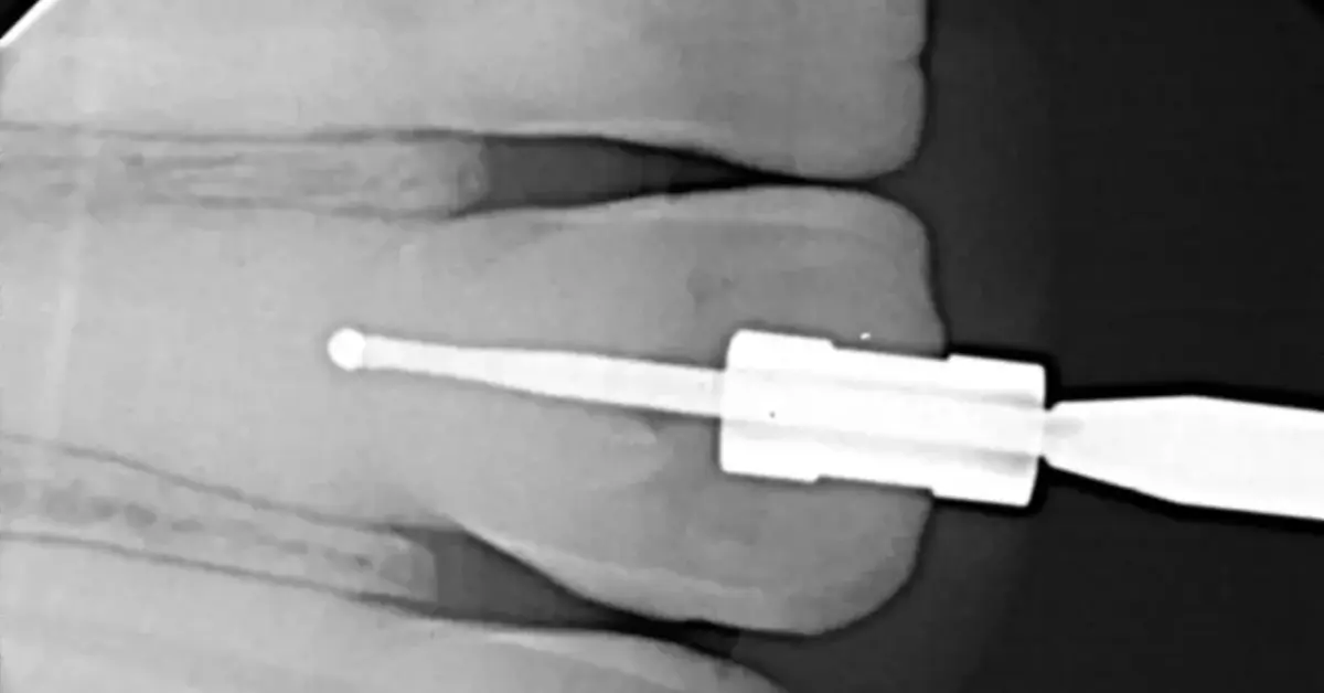Guided Endodontics in a Calcified Tooth 11 Following Trauma