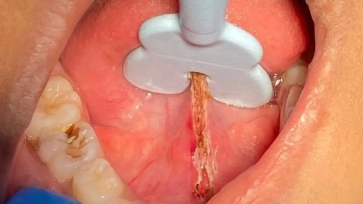 Tongue Tie Release