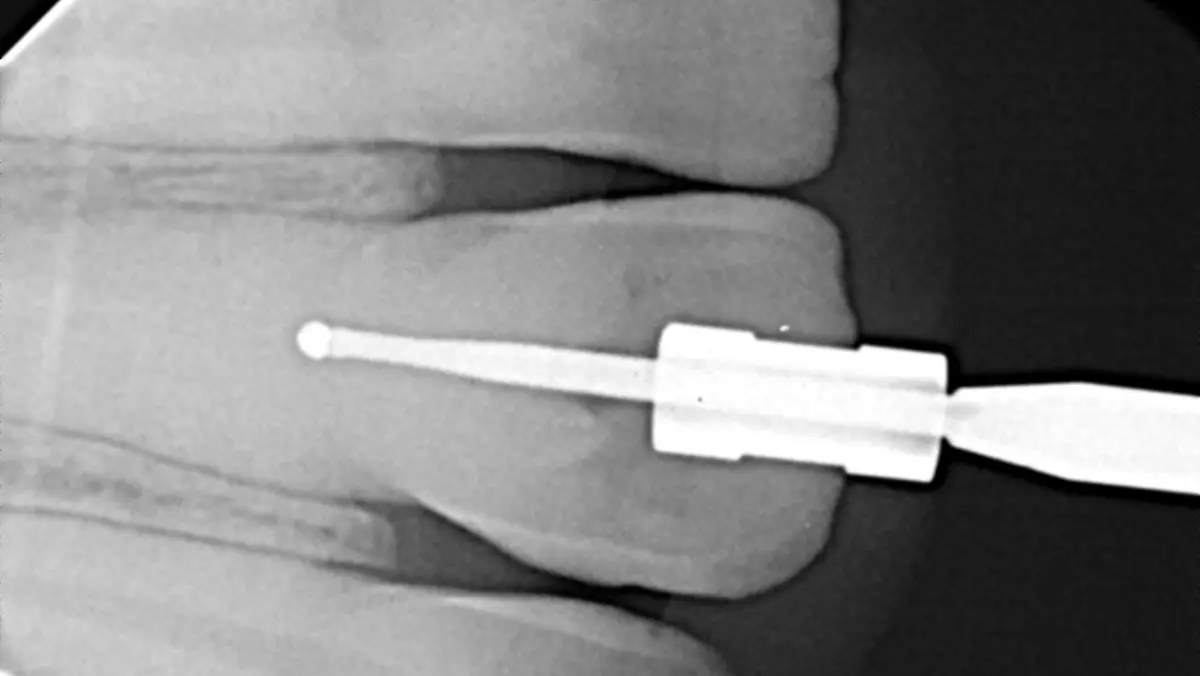 Guided Endodontics in Chennai