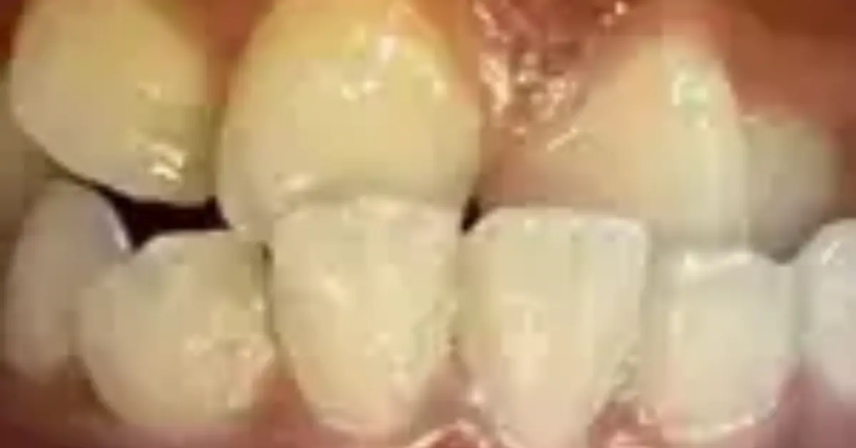 Correction of Skeletal and Dental Class III Malocclusion to Class I with Reverse Pull Headgear and 2x4 Appliance