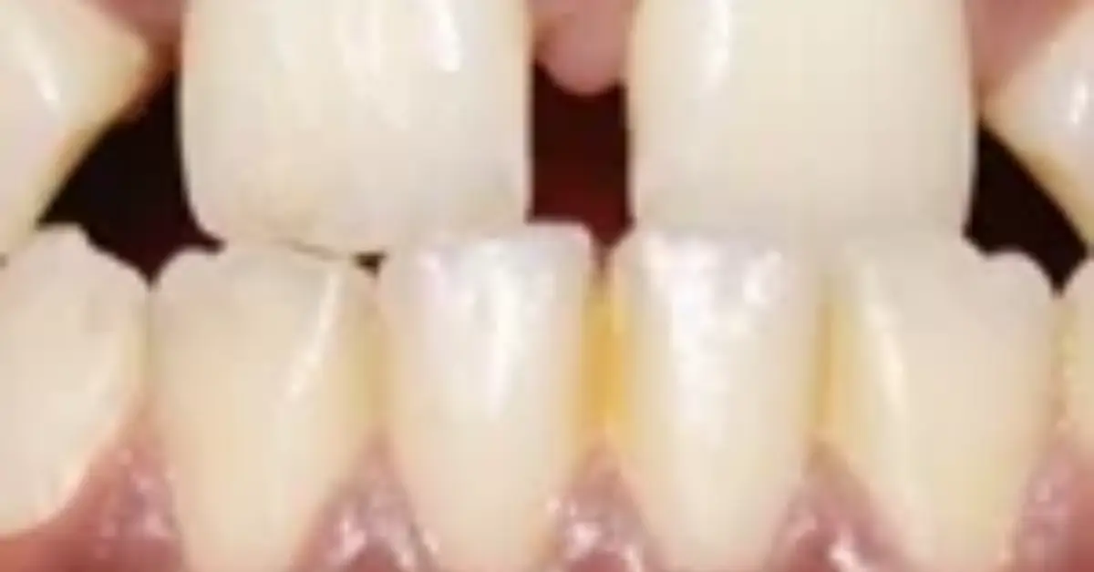 Multidisciplinary Management of Congenitally Missing Lateral Incisors in a Skeletal Class III Case