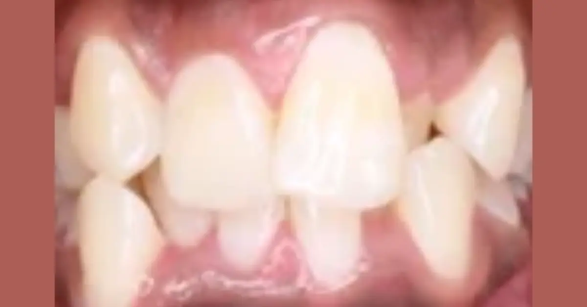SARPE for Severe Maxillary Constriction in an Orthodontic Case