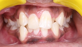 SARPE for Severe Maxillary Constriction in an Orthodontic Case