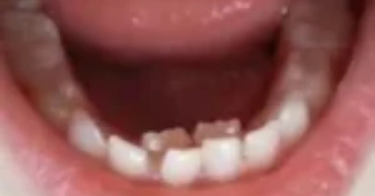 Serial Extraction of Milk Teeth – Why Early Guidance is Key for Permanent Teeth alignment