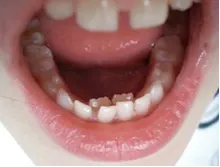 Serial Extraction of Milk Teeth – Why Early Guidance is Key for Permanent Teeth alignment