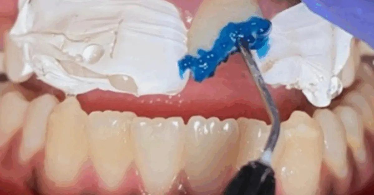 Saving a Broken Front Tooth in a 13-Year-Old Girl